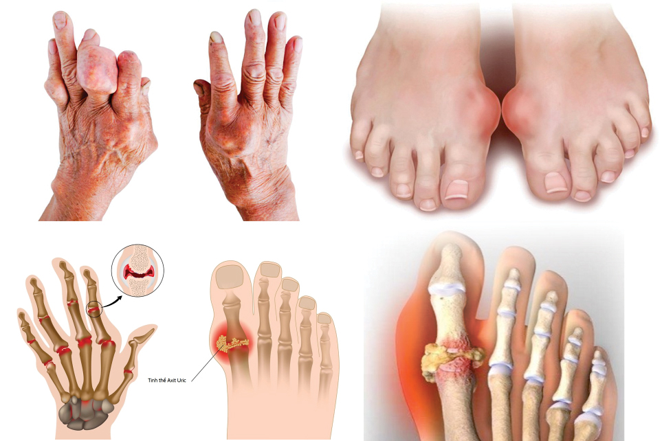 Gout — viêm khớp do axit uric tích tụ