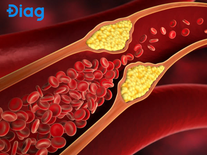 Rối loạn mỡ máu — mảng bám cholesterol trong mạch máu